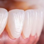 ابتسامة هوليوود – تجميل الأسنان وابتسامة مثالية